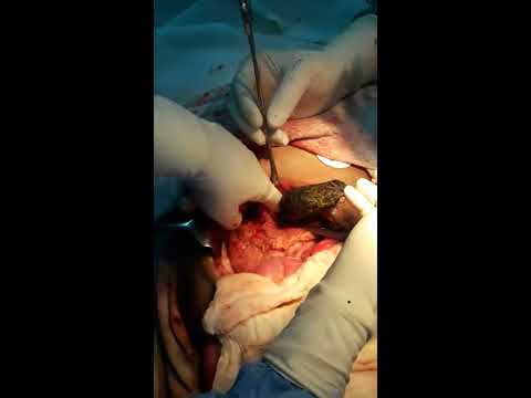 Trichobezoar With Perforation