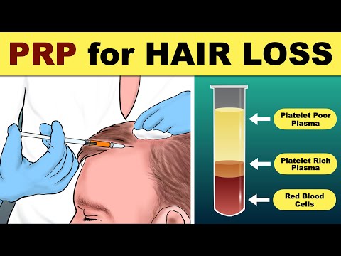 PRP Hair Treatment | prp hair loss treatment before and after | Hair loss Treatment