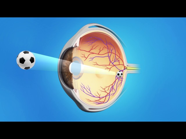 Cataract Phaco with Toric Lens