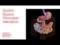 Gastric Bypass Procedure Animation J J MedTech
