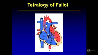 Introduction to common congenital cardiac lesions – Prof David Celermajer