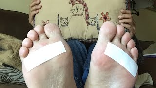 【リウマチ  強皮症】本当は一番痛い？足の裏初公開／リウマチは足指の関節も痛みます