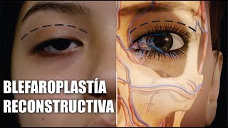 BLEFAROPLASTÍA Reconstructiva Superior 👁️ PTOSIS PARPEBRAL 👀 Dr ALBERO CALVO