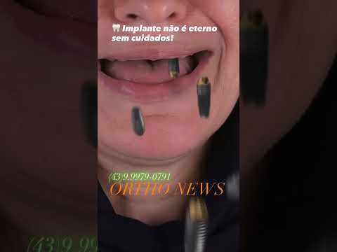 “Dente natural exige cuidado. Implante dentário exige cuidado redobrado!”