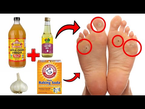 14 Proven Home Remedies For Corns & Callus Removal THAT WORK!