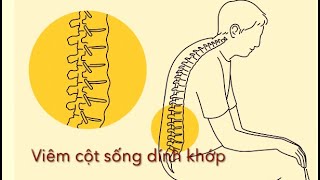 Hiểu về viêm cột sống dính khớp
