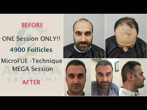 Amazing Transformation | Hair transplant result in ONE session ONLY !! MicroFUE (4900 Follicles)