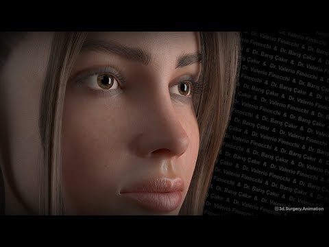 SPQR TECHNIQUE EXPLANED BY DR FINOCCHI AND SPECIAL GUEST DR BARIS CAKIR.