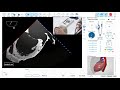 Optimal Imaging Of The Left Atrial Appendage LAA