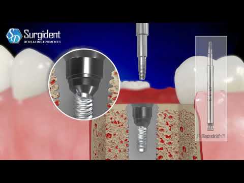 Implant Fixture and Screw Remover Kit
