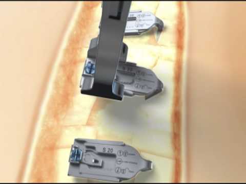Sternal Talon® – Long term removal after bony healing