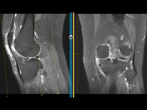 How to diagnose a meniscus tear