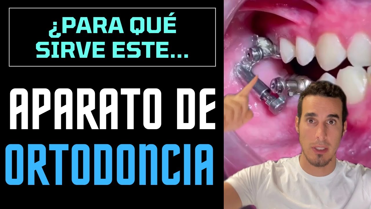 ¿Qué es este APARATO DE ORTODONCIA y para qué sirve - Dispositivo ortopédico Herbst