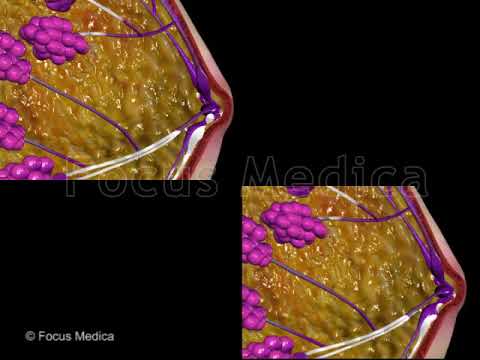 Mastitis - Animated Atlas of Breast and Gastric Cancer - YouTube