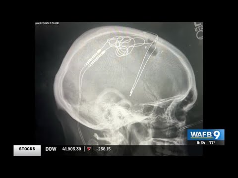 YOUR HEALTH: Long term relief for Dystonia sufferers