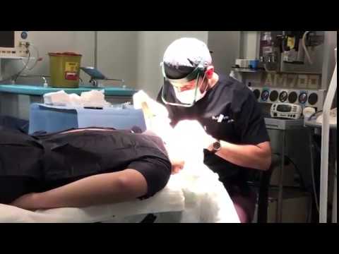 Отзив за присаждане на коса в Турция с Dr Demir – реален пациент