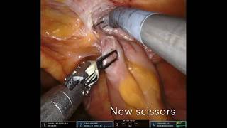 Download Lagu Robotic right hemi-colectomy. Intracorporeal anastomosis Thumbnail
