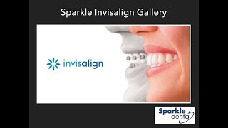 preview picture of video 'Invisalign Before and After'