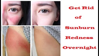 How to Get Rid of Sunburn Redness Overnight