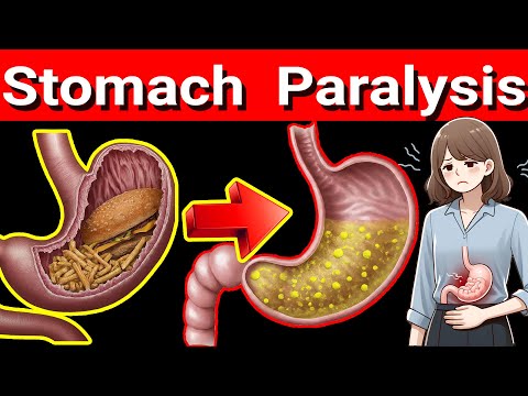 Stomach Paralysis  5 Warning Signs You Shouldn't Ignore! Gastroparesis