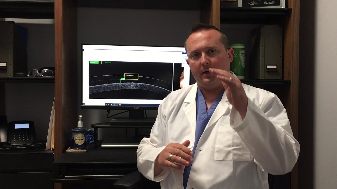 Scleral Lenses for Keratoconus