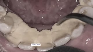 Can You Watch Till the End? Top 3 Most Impressive  Tartar Removals