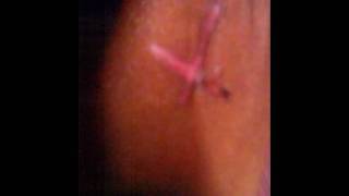 Stigmata -the five wounds of Jesus Christ in living person at Tamil Nadu, India