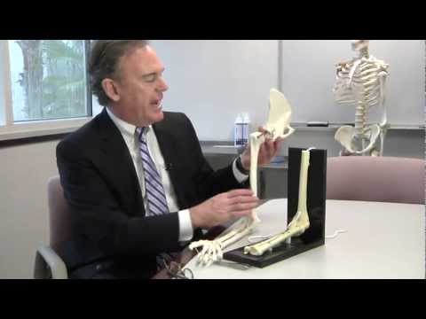 New Way for Repairing a Ruptured Bicep Tendon - Mayo Clinic