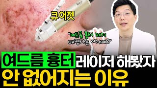 여드름 흉터는 레이저 매일 해봤자 절대 안 없어져요! 그럴 때는 큐어젯 한 번 도전해보세요!