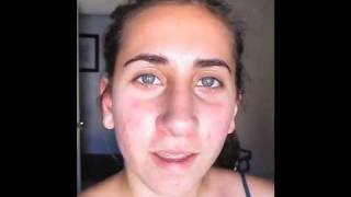 VLog of my Rhinoplasty Surgery, Recovery, #13
