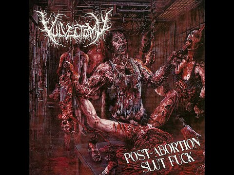 Vulvectomy - Eugenic Sterilization