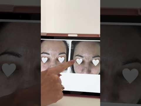 Miniatura: Walka z przebarwieniami!🤍 Kosmetolog Kasia