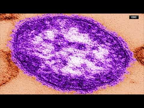 NJ Measles Warning
