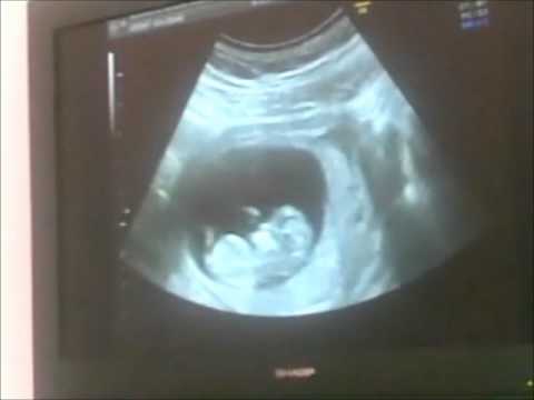 Come fai a sapere distorsione del ginocchio Anatomia topografica della faringe e dellesofago cervicale