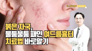 痘疤与痘红全面解析:红印、凹陷与不平整纹理的治疗方法