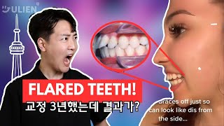 FLARED TEETH: THE ULTIMATE CURE (AND IT’S NOT EXTRACTION)