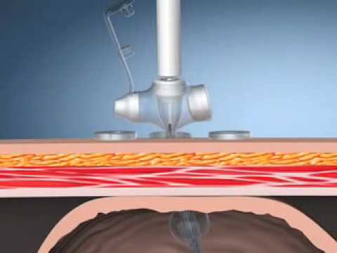 Kimberly-Clark MIC-KEY* J/TJ Introducer Kits - Radiologic Placement
