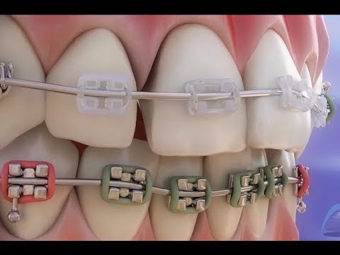 正畸 – 牙科矫治器的部件和功能 ©