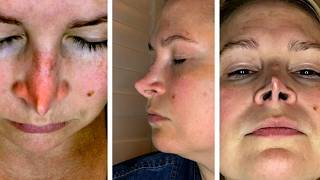 r/AITA for Mocking a Woman's Terrible Nose Job?