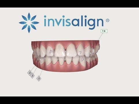 Invisalign