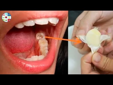 download Cara Ampuh Menghilangkan Rasa Sakit Gigi Berlubang, download video viral Cara Ampuh Menghilangkan Rasa Sakit Gigi Berlubang gratis, unduh video klip Cara Ampuh Menghilangkan Rasa Sakit Gigi Berlubang