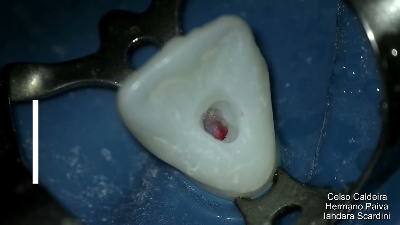 Endodontia Cirurgia de acesso Incisivo Central Superior