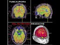 Tuscaurora Malnutrition Headache Full Album