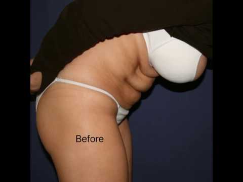 Vaser Lipoabdominoplasty