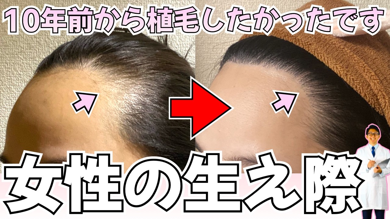 【女性 植毛】生え際を丸く可愛くしたくて植毛しました【おでこ｜ヘアライン矯正】