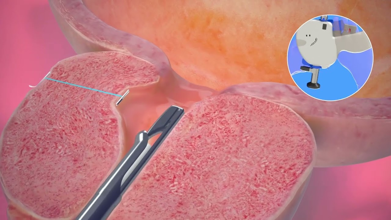 Urolift for BPH Procedure Animation