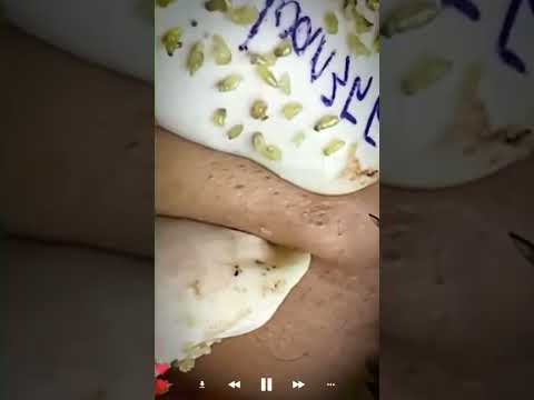 Skincare | Blackheads Removal #616 #tweezers skincare #blackheads blackheads