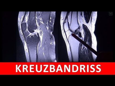Ob Flüssigkeit kann sich im Kniegelenk auflösen Von Rückenschmerzen, die tun