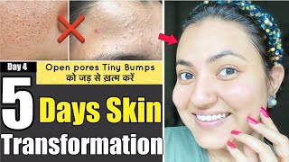 5 DAYS SKIN TRANSFORMATION CHALLENGE : Remove Tiny Bumps Open Pores/Clogged Pores in 5 Days