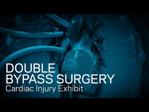 Double Bypass Surgery - Cardiac Injury Exhibit